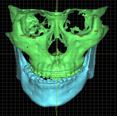 掃描顯示面部不對稱的患者